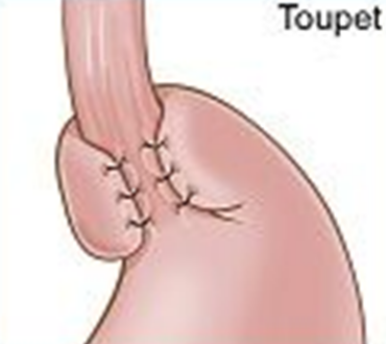 Toupet Fundoplication